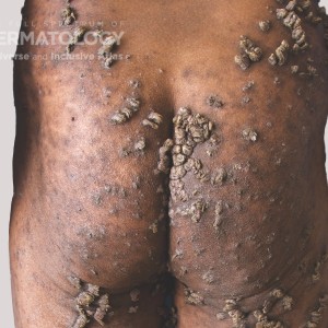 Keratosis Lichenoides Chronica_C_Ezekwe14.jpg