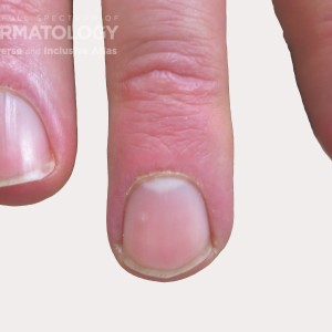 dermatomyositis type a fingernail_11.jpg