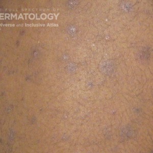 Pityriasis Rosea_1.jpg