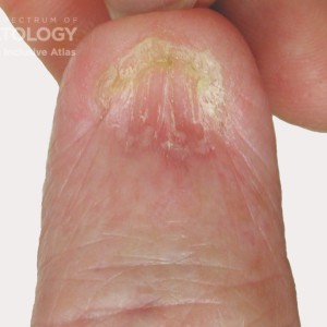 lichen planus nail_A_1_.jpg