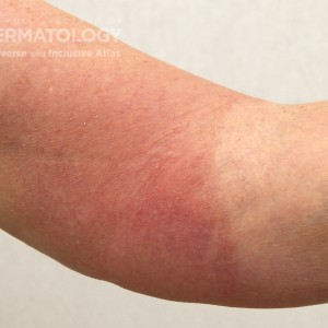 Eosinophilic Cellulitis _2_B_arm2.jpg