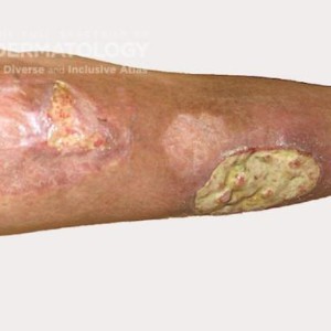 pyoderma gangrenosum type C_.jpg