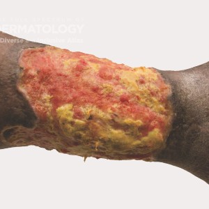 Pyoderma_gangrenosum_E_Leg_.jpg