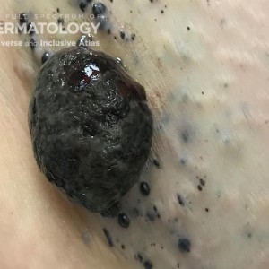 Melanoma_In_Transit_A_60980 .jpg