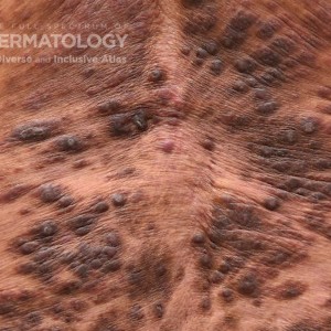 Psoriasis_C_closeup.jpg