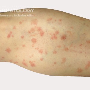 guttate psoriasis LE_.jpg