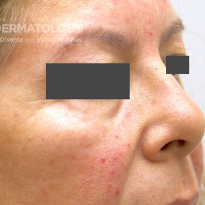 Rosacea3_A_Profile.jpg