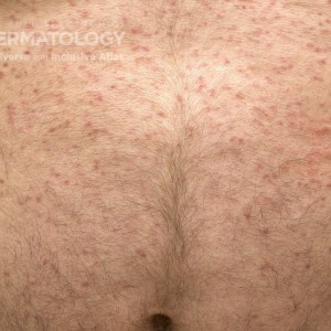 Mastocytosis_4_B_chest3.jpg