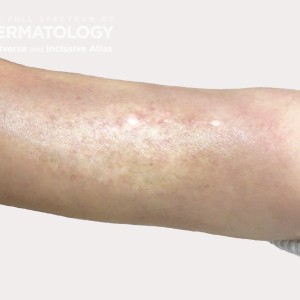 morphea type B arm23_.jpg