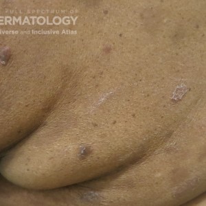 Pityriasis_Rosea_ type D skin trunk.jpg