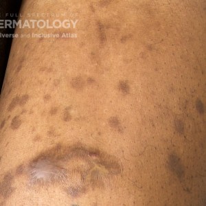 Pityriasis_Lichenoides_Chronica_D_arm1.jpg