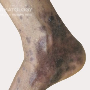 hyperpigmentation type e foot.jpg