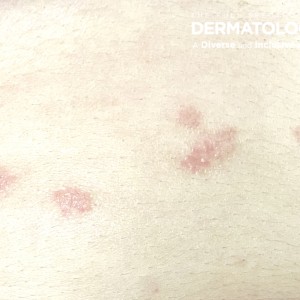 Pityriasis Rosea_A_JDD2.jpg