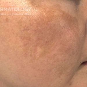 Melasma_C_JDD.jpg