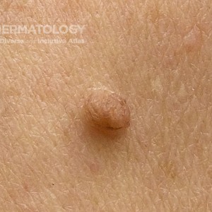 CompoundNevus_A_Back1.jpg