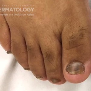 onychomycosis_D_DIR 61328.jpg