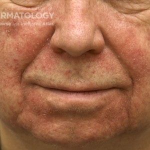 ActinicKeratosis_B_face10.jpg