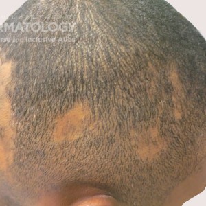 alopecia areata type d skin_Profile.jpg