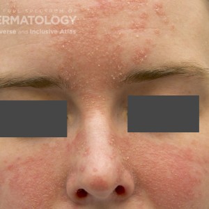 Seborrheic_Dermatitis_A.jpg