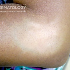 hypopigmentation type e_elbow.jpg