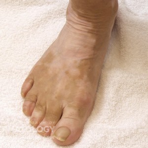 Vitiligo_B_Foot_13.jpg