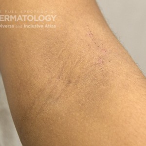 AtopicDermatitis_C_Adusumilli_Arm.jpg