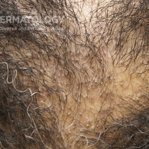 CCCA_D_Scalp_1Closeup.jpg