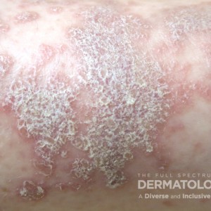 lichen planus type A leg closer.jpg