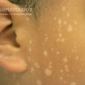 tinea versicolor type D.jpg