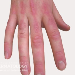 dermatomyositits hand type a_22.jpg