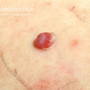 Pyogenic Granuloma 2_Friedman3 .jpg