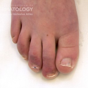 Paronychiao_A_footnail2.jpg