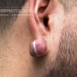 Keloid_b_Ear3 .jpg