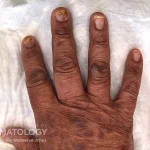 Psoriatic_Nail_D_Fullhand.jpg