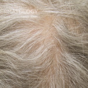 AndrogenicAlopecia_A_Scalp.jpg