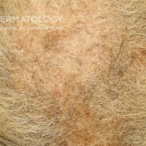 CCCA_Scalp_B2.jpg