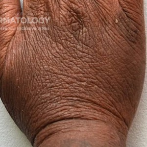 Atopic_Dermatitis_E_Hands_1.jpg