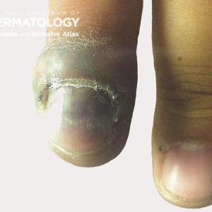 paronychia type C_Finger1_.jpg