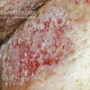 Familial Benign Pemphigus_B_Cohen1_Closeup.jpg