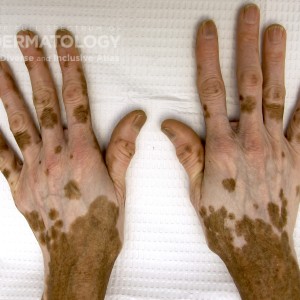 vitiligo_e_hands_2.jpg