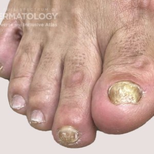 onychomycosis_B_DIR 61540.jpg