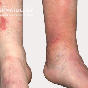 stasis dermatitis type A_Legs1_.jpg