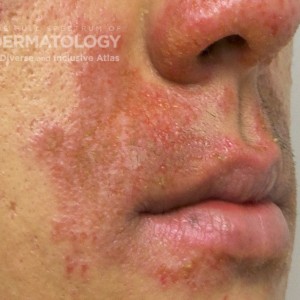 Perioral_Dermatitis_C_Profile.jpg