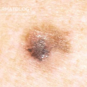 lentigo_maligna_melanoma_A_ 58356.jpg