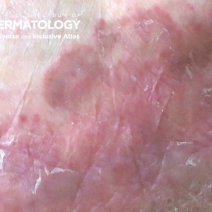 tinea pedis type A_Fullfoot_closeup_.jpg