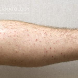 Mastocytosis_3_B_Arm10.jpg