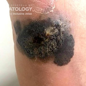 Acral_Melanoma_A_ 61379.jpg