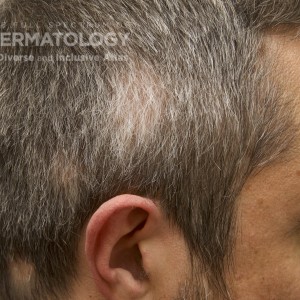 AlopeciaAreata_B_Adusumilli_Profile_1.jpg