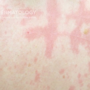 dermatographism type A_11.jpg