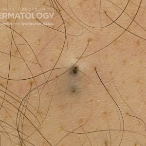 Epidermoid_Cyst_A_Trunk1.jpg